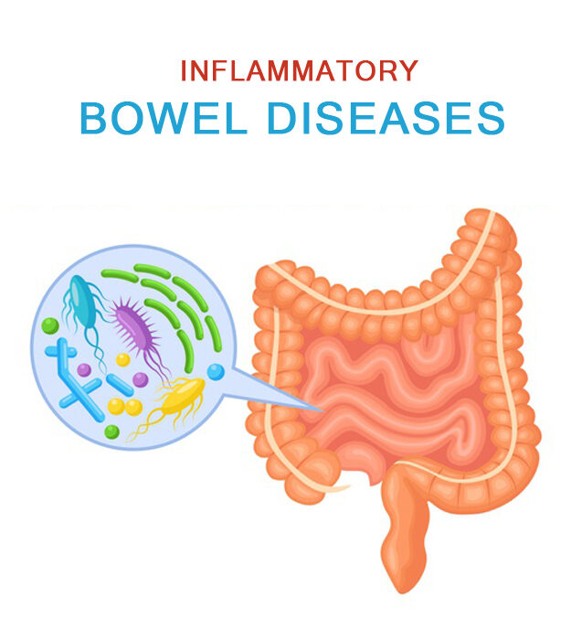 Inflammatory-Bowel-Diseases-v2